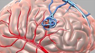 Arteriovenous Malformation (AVM)