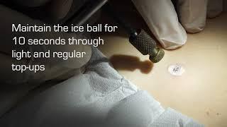 Cryosurgery Demonstration