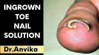 Ingrown Toe Nail Solution - Dr. Anvika - 9999 747 717 // 8287001211 !!