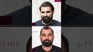 Celebrated Cricketer Mohd Shami's Hair Transplant Results after 1 Year 4 Months at Eugenix