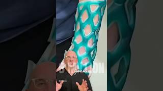 New Waterproof Cast Option For Broken Bones 