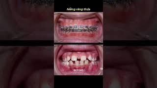 Braces process - Sparse teeth