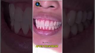 braces transformation! #shortsvideo #youtubeshorts #viralshorts #dentistrymyworld