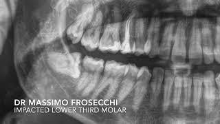 Rapid impacted lower third molar extraction