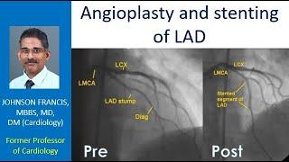 Angioplasty and stenting of left anterior descending coronary artery (LAD)