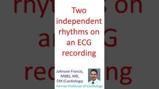 Two independent rhythms on an electrocardiographic recording