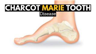 CHARCOT MARIE TOOTH DISEASE (CMT)