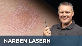 Narben lasern: Lohnt sich das wirklich? | der Faszienexperte erklärt