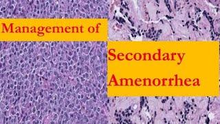 Management of Secondary Amenorrhea | Obstetrics and Gynaecology