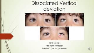 DISSOCIATED VERTICAL DEVIATION