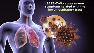 Severe Acute Respiratory Syndrome (SARS)