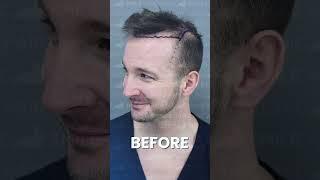 GET YOUR HAIR BACK - 12 MONTHS RESULT - HAIR TRANSPLANT