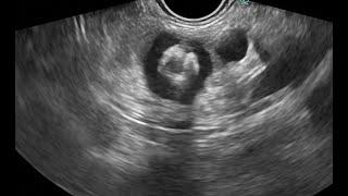 FLORIDA LIVE (AUG 21-23, 2025) VIDEO: CALCIFICATION WITHIN PANCREATIC CYST-GUESS THE DIAGNOSIS