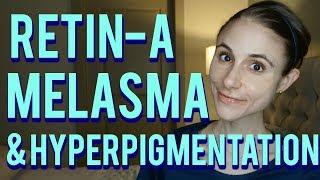 RETIN-A FOR MELASMA & HYPERPIGMENTATION|Dr Dray