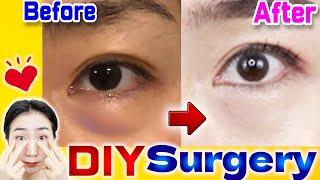 How to Best Remove Under Eye Bags ️ Naturally in 7 Days