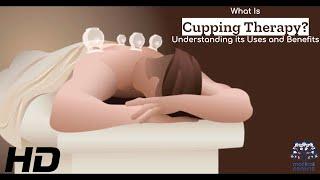 Cupping Therapy: The Art of Natural Healing