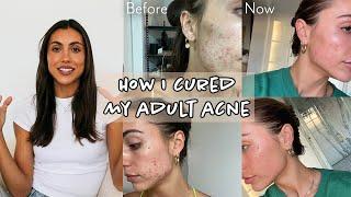 My Skincare Journey | What Didn’t Work - What Worked | Emotions & Treating Root Causes | Sami Clarke