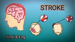 stroke aur stroke ko kaise prevent kare in hindi & English / cerebrovascular accident /#neurology