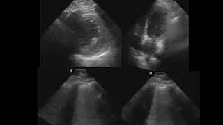 POCUS for Acute Dyspnea - Dx in seconds, not hours