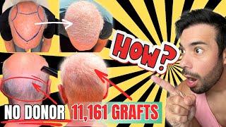 IMPOSSIBLE Hair Transplant 11K Grafts HOW?