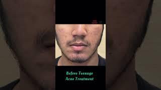 Teenage acne Treatment | Dermatologist in Punjab | Dr Ashima Goel| PARISA skin clinic | pimples