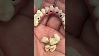 Superman full mouth implants zirconia!