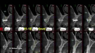 Two staged augmentation with tenting screws and straumann implants