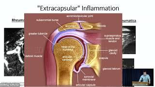 Polymyalgia Rheumatica: What has changed since 1957?