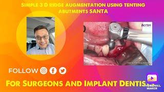 Simple 3 D ridge augmentation using tenting abutments SANTA