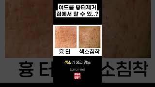 여드름 흉터가 있다면 주목!!  | 피부과전문의 김홍석