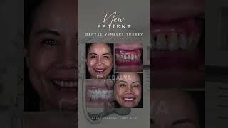 Porcelain Dental Veneers in Turkey, Antalya - Zirconium Teeth