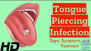 Tongue Piercing Gone Wrong? Recognize Infection Signs and Solutions