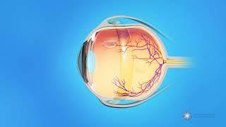 What is scleral buckle surgery?