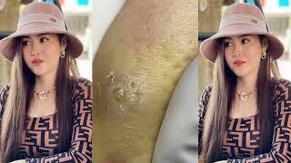 Best bleckheads,Blackheads Removal,Blackhead Extractions, Выдавливание черных точек прыщей 2022