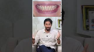 Prepless Veneers: A Case Discussion I Dr. Khalid Aldabbas