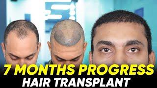 Hair Transplant in Salem | Best Results & Cost of Hair Transplant in Salem