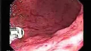 Video Endoscopy of Severe gastritis