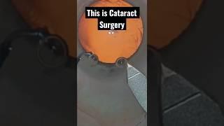 Entire CATARACT surgery in less than a minute