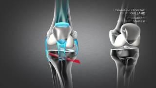 Tibial Valgus Osteotomy