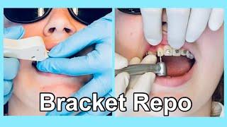 #7 BRACES VISIT PH2Bracket Repositioning!