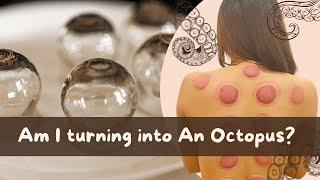 I tried Cupping Therapy for the First time !!