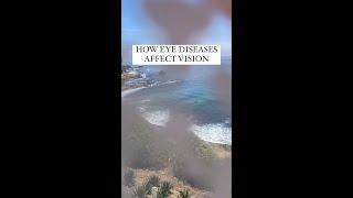 How Eye Disease Affect Vision #shorts #vision