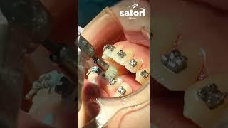 Чистка зубов с брекетами #брекеты #braces #ортодонтия