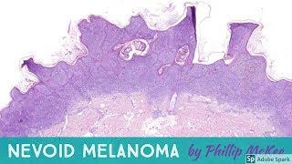 Nevoid melanoma explained by Dr. Phillip McKee