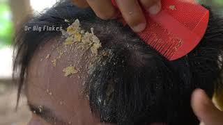 Best Scratching Big Flakes!! | Cured Dry Itchy Scalp Of My Husband's Head #85