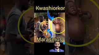 Kwashiorkor and marasmus #shorts @pna1