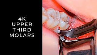 Third Molar Removal in 4K | Impacted Maxillary Third Molars | Erupted Lower | OnlineExodontia.com