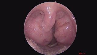 Grade IV Tonsil Hypertrophy with An Elongated Uvula