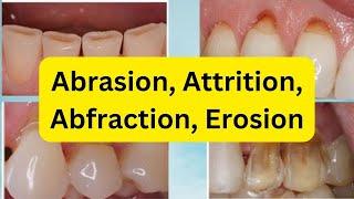 Abrasion, Attrition, Erosion, Abfraction (SIMPLIFIED)