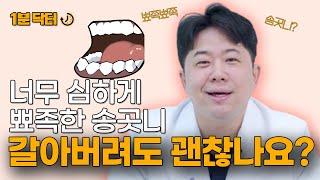 [1분닥터]송곳니, 유전으로 너무 뾰족한데... 갈아버릴 수 있나요?